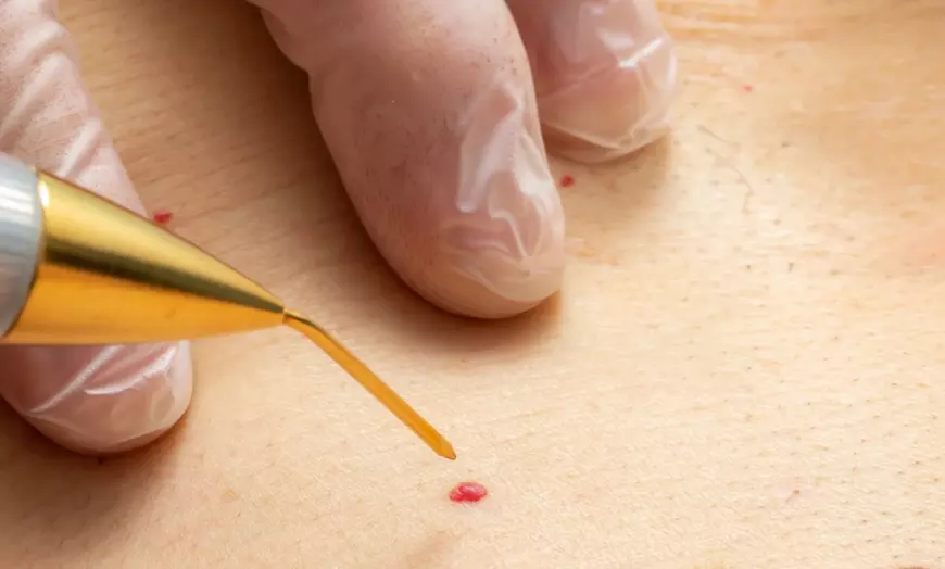 Image 1: Effortless Removal of Skin Tag or Blemish