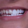 Image 1: 1 Veneer at Your Covina Family Dentistry 