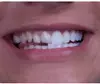 Up to 70% Off on Dental Implant / Corona / Veneer at Your Covina Family Dentistry