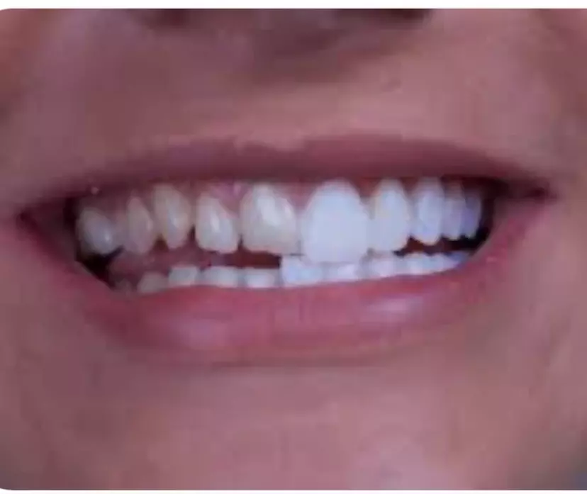 Up to 70% Off on Dental Implant / Corona / Veneer at Your Covina Family Dentistry - Primary Image