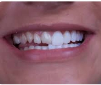 Consultation Exam & 1 Veneer - Your Covina Family Dentistry