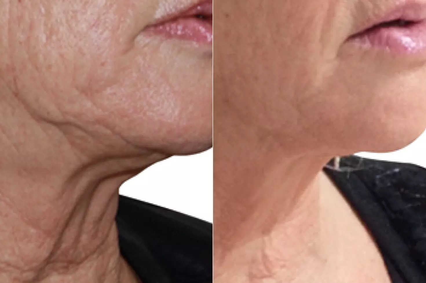 HiFu Treatments for Full Face and/or Neck with Jowls and Jawline