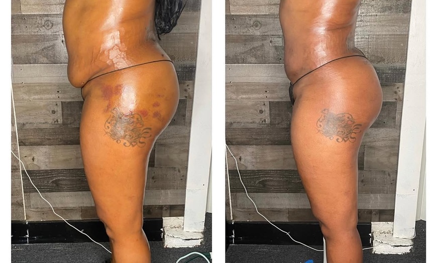 Image 1: Heal and Restore: Lymphatic Post-Op Massage for Optimal Recovery