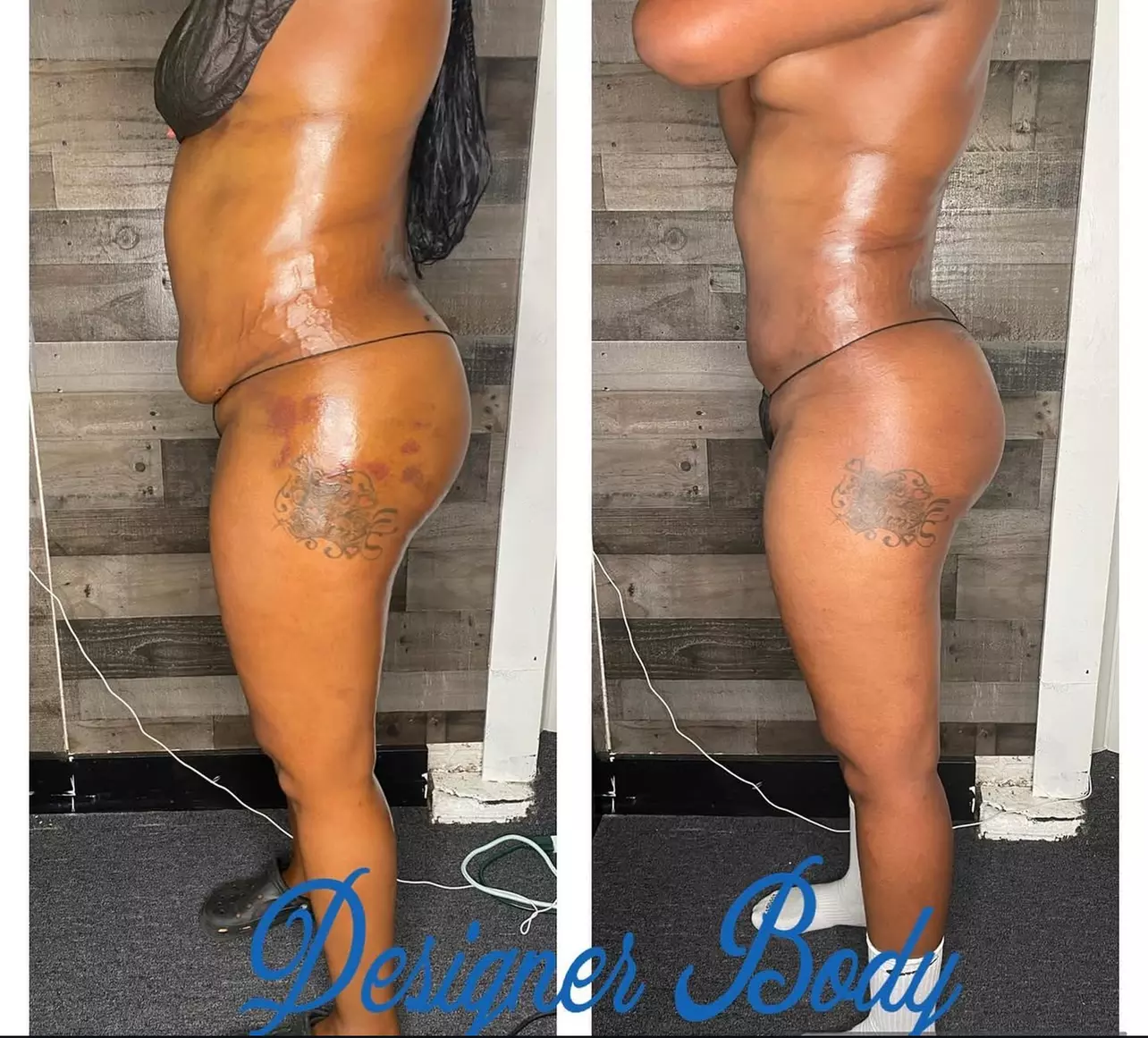 Recovery Made Easy: Lymphatic Post-Op Massage Package Awaits at Designer Body Studio (Up to 50% Off) - Primary Image