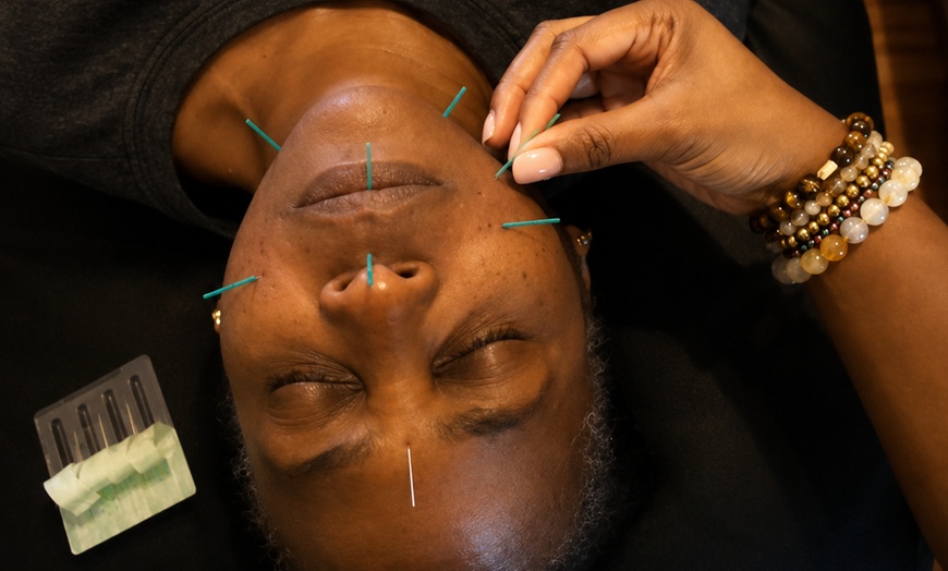 Image 2: Up to 43% Off on Acupuncture at The Golden Life Acupuncture