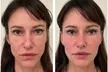 Smooth Out Fine Lines with 20 Units of Botox or 0.5 or 1 ml Syringe of Juvéderm (Up to 62% Off) - Second Medium