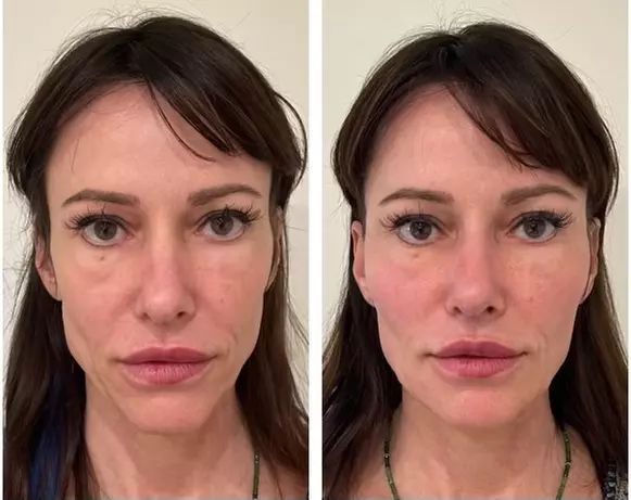 Smooth Out Fine Lines with Botox or Juvéderm (Up to 62% Off)