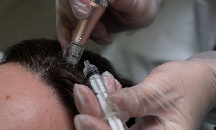 Image 2: Up to 40% Off on Hair Restoration - Non-Surgical at Benefit Aesthetics