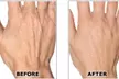One Syringe of Radiesse for Neck / Décolleté and Hand Rejuvenation at No Pain All Gain Spa (Up to 30% Off) - Second Medium