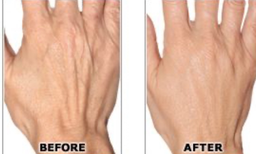 Image 3: One Syringe of Radiesse for Neck / Décolleté and Hand Rejuvenation at No Pain All Gain Spa (Up to 30% Off)