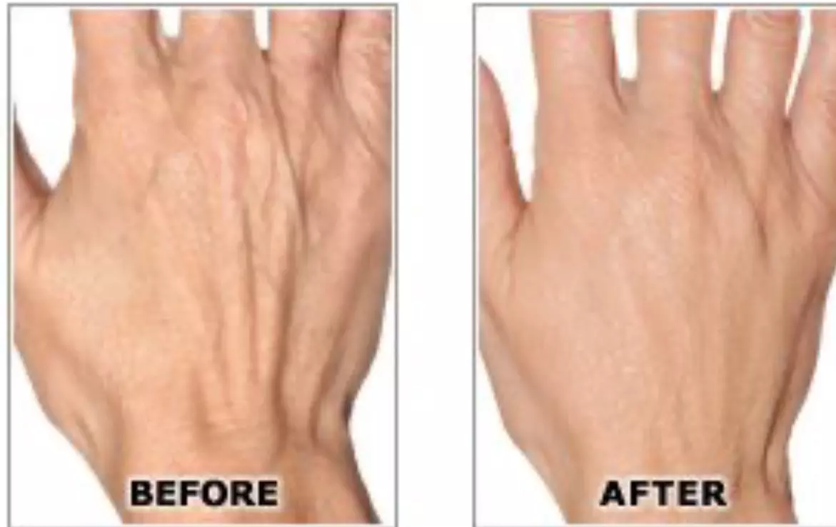 One Syringe of Radiesse for Neck / Décolleté and Hand Rejuvenation at No Pain All Gain Spa (Up to 30% Off)