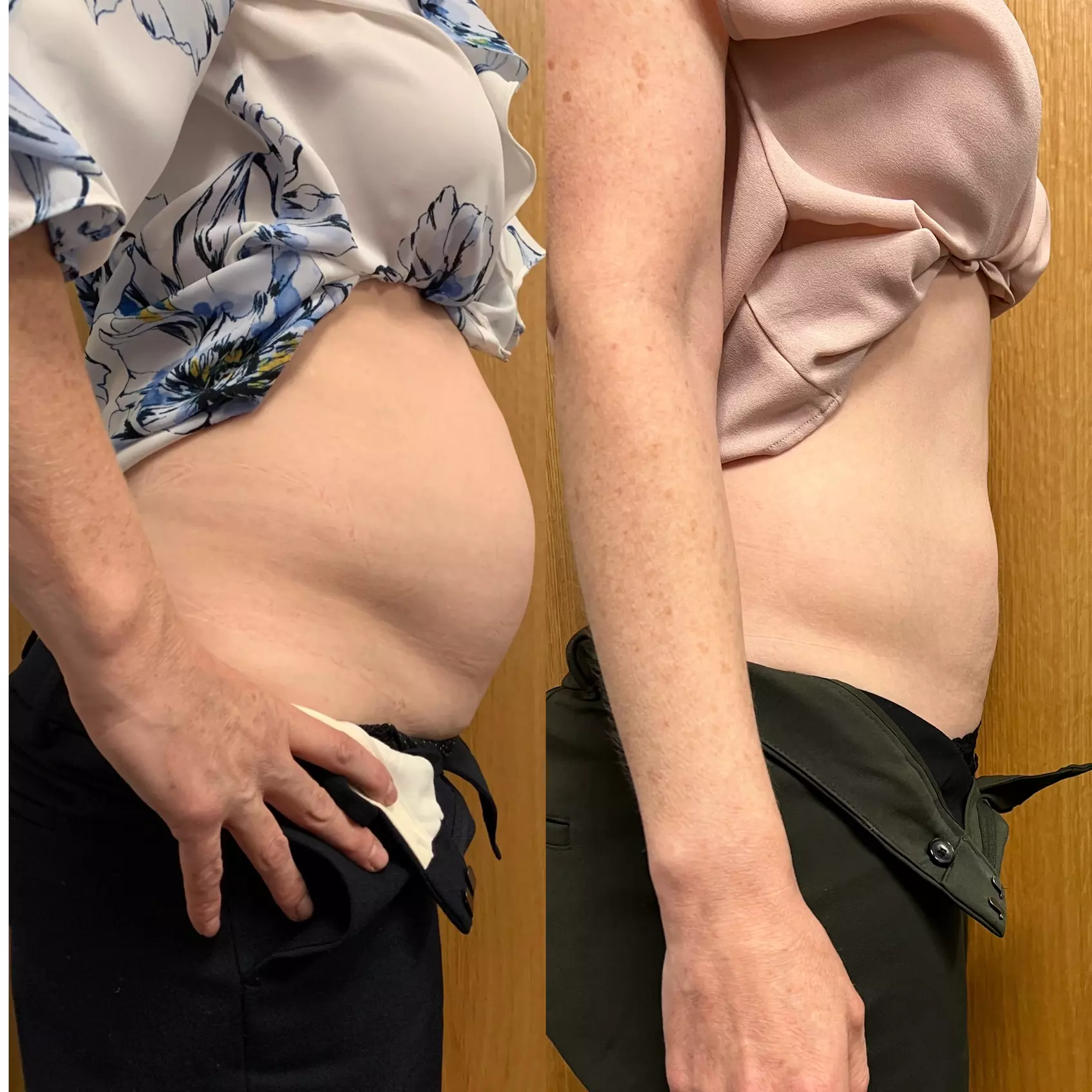 One session of Electromagnetic Sculpting for muscle toning