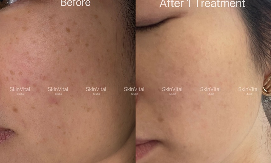 Image 3: Pico Laser Sessions for Small Targeted Areas – 1 or 3 Options 