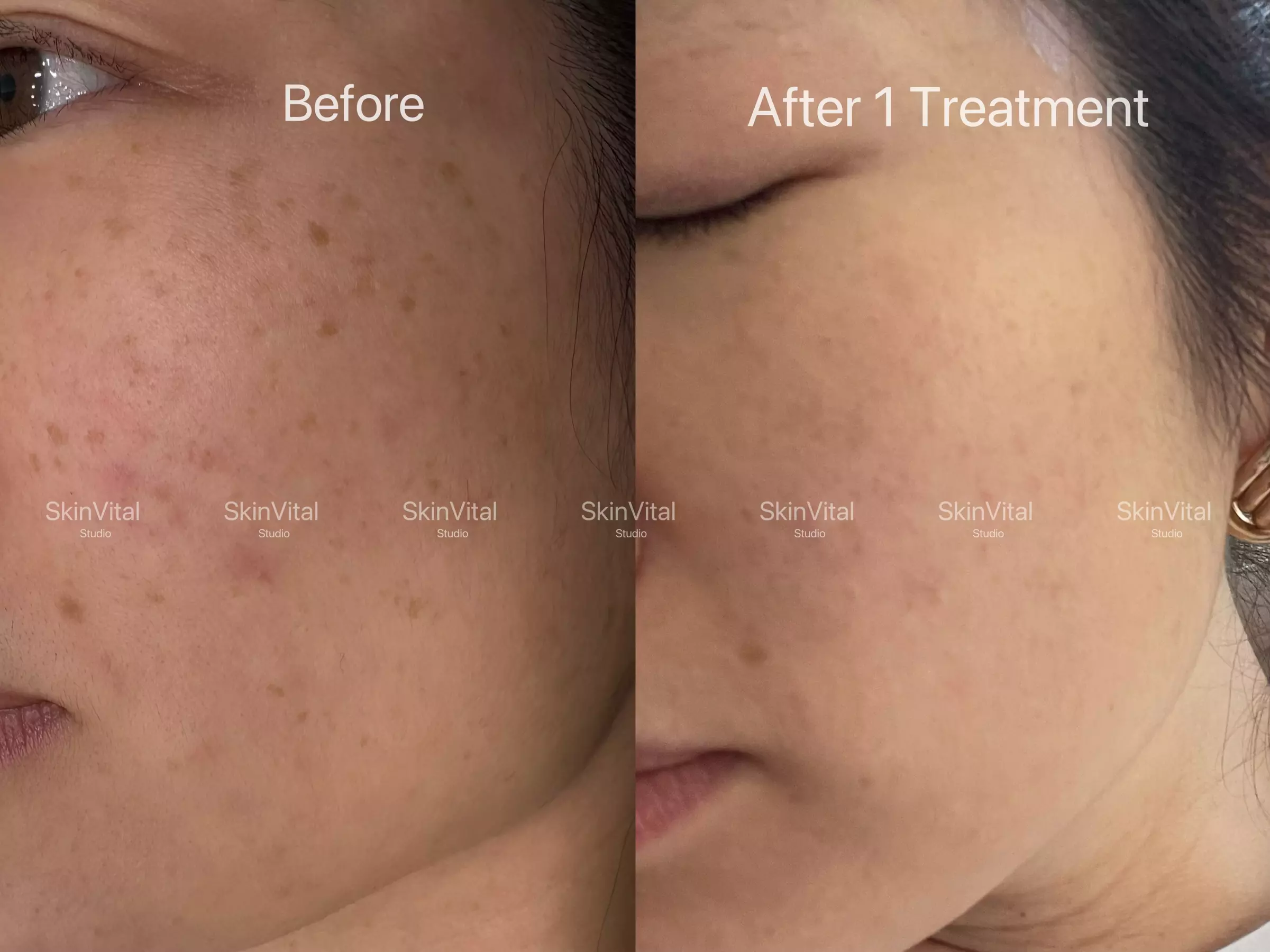 Pico Laser Sessions for Small Targeted Areas – 1 or 3 Options