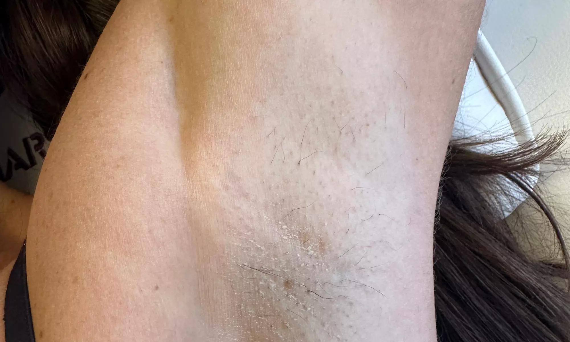 Up to 50% Off on Laser Hair Removal at Naked Lasers