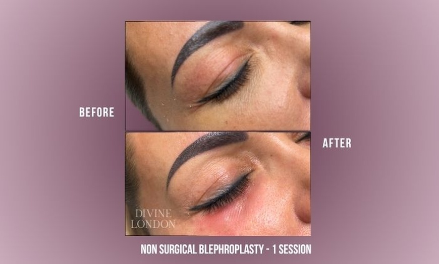 Image 4: Polynucleotides Regenerative Treatment at Divine Aesthetics in London