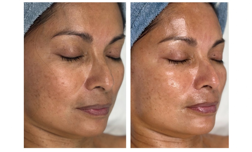 Image 4: Advanced Chemical Peel or 2-Hour Anti-Aging Facial at RISE Skin Spa