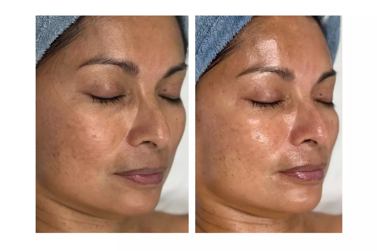 Advanced Chemical Peel + 2-Hour Anti-Aging Facial at RISE Skin Spa
