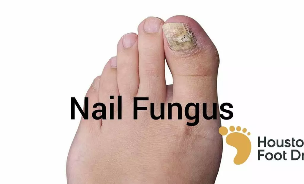 4 Fungal Laser Treatment, 3 Ultrasound or PBM Laser or 1 PRF Treatment