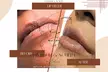 Perfect Your Pout with Dermal Filler - 0.5ml or 1ml  (Up To 60% Off) - Image 4