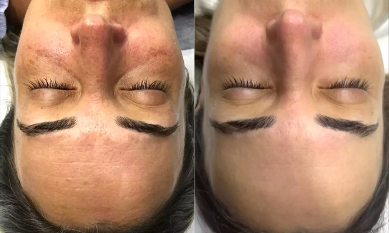 Up to 65% Off on Facial at The girl spot spa aesthetic - Primary Image