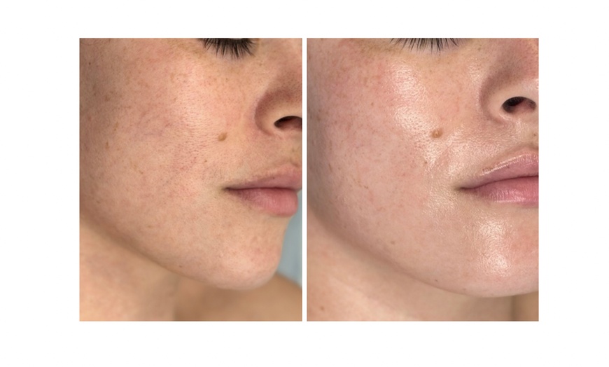 Image 5: Glow + Sculpt: The Ultimate Hydraglow Microdermabrasion