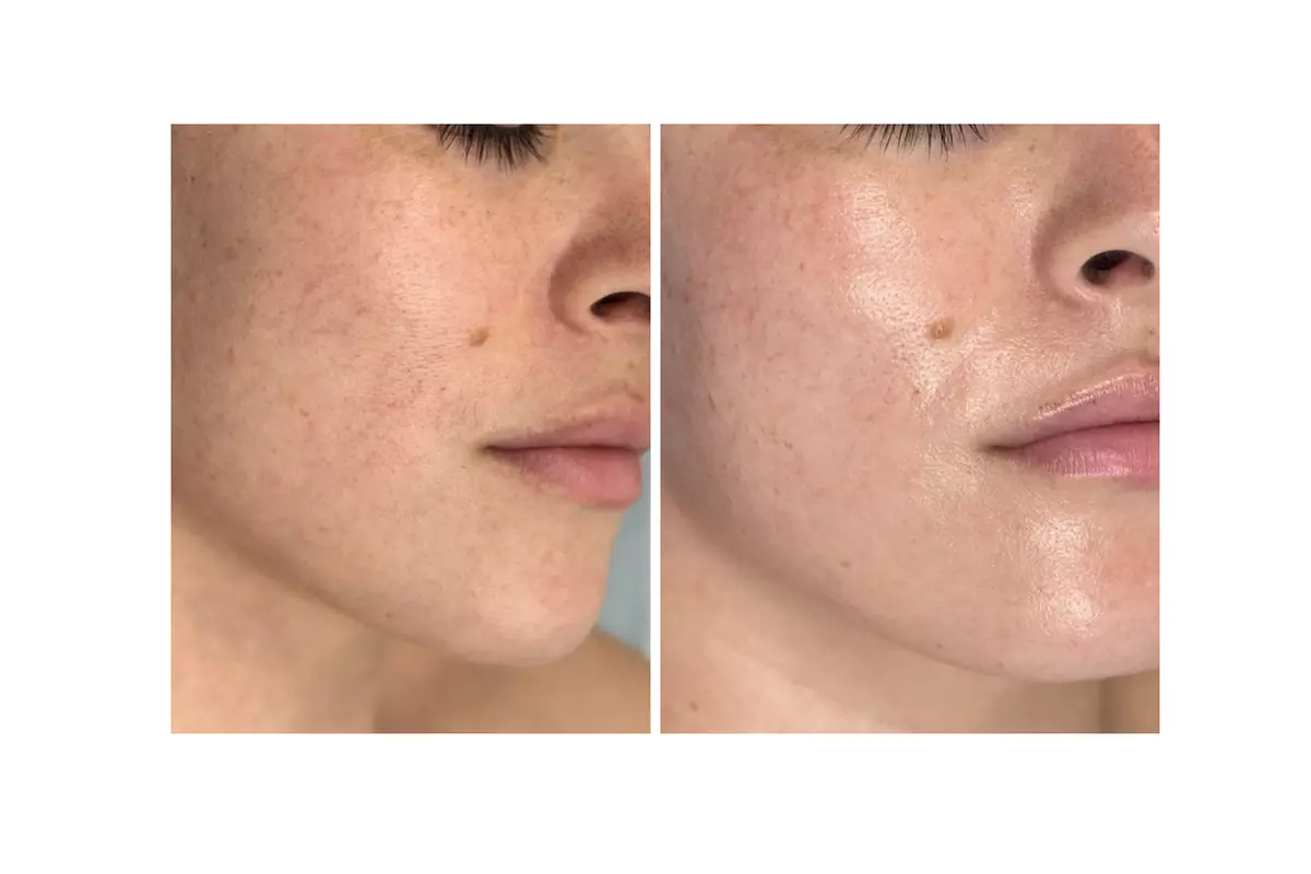 Glow + Sculpt: The Ultimate Hydraglow Microdermabrasion