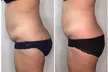 One or Three Cryo Slimming / Cryosculpting session + Optional Full Body Red Light Therapy (Up to 57% Off) - Second Medium