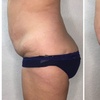 Image 2: 1 or 3 Cryo Slimming Sessions + Optional Full Body Red Light Therapy