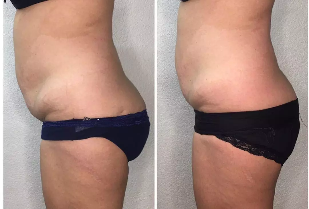 1 or 3 Cryo Slimming Sessions + Optional Full Body Red Light Therapy