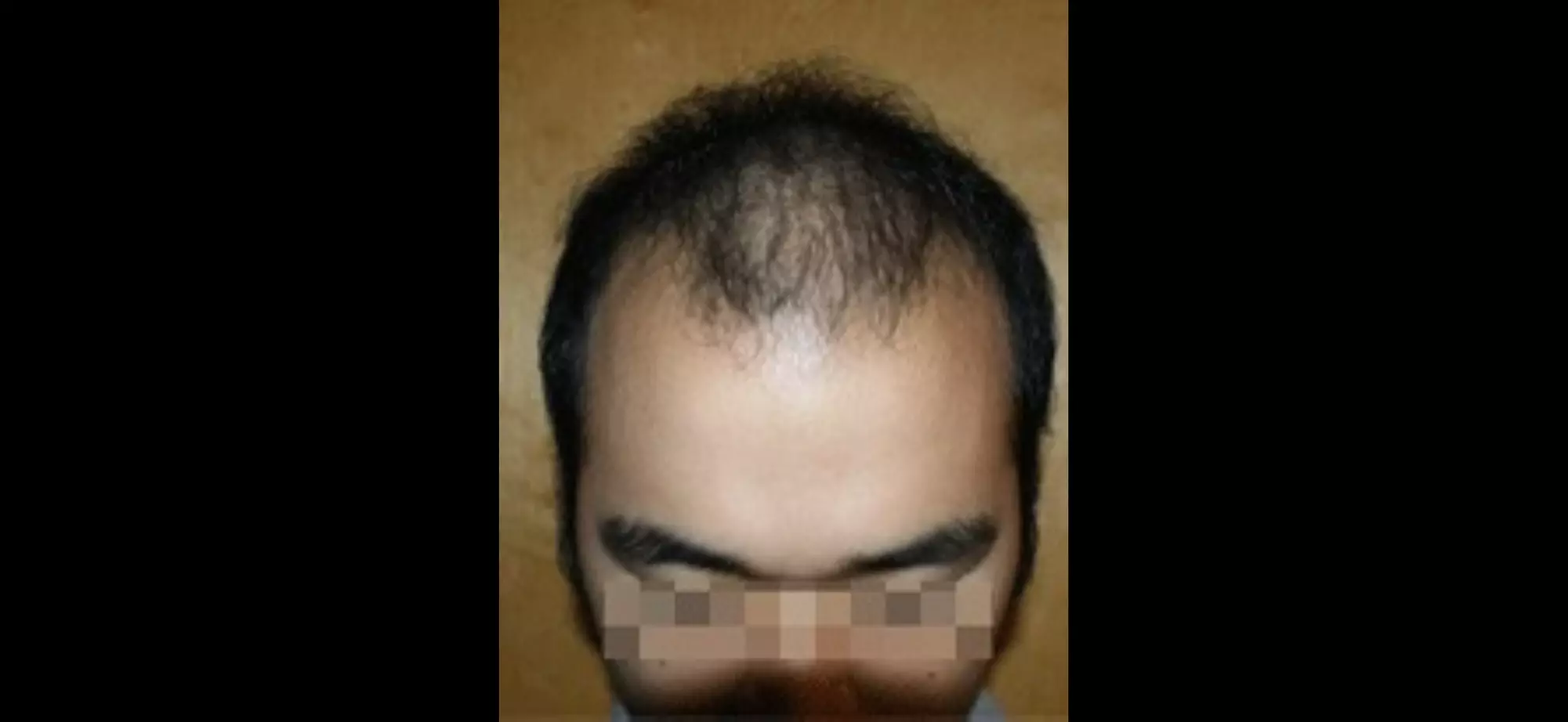 Hair, Scalp Analysis and Take Home Product with Optional Treatment