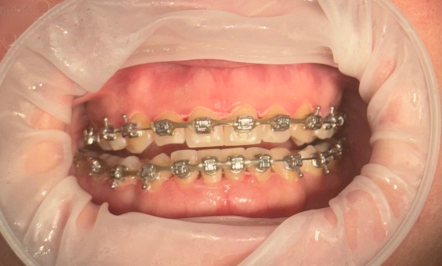 Image 3: Skaling, piaskowanie i więcej – także dla osób z aparatem stałym