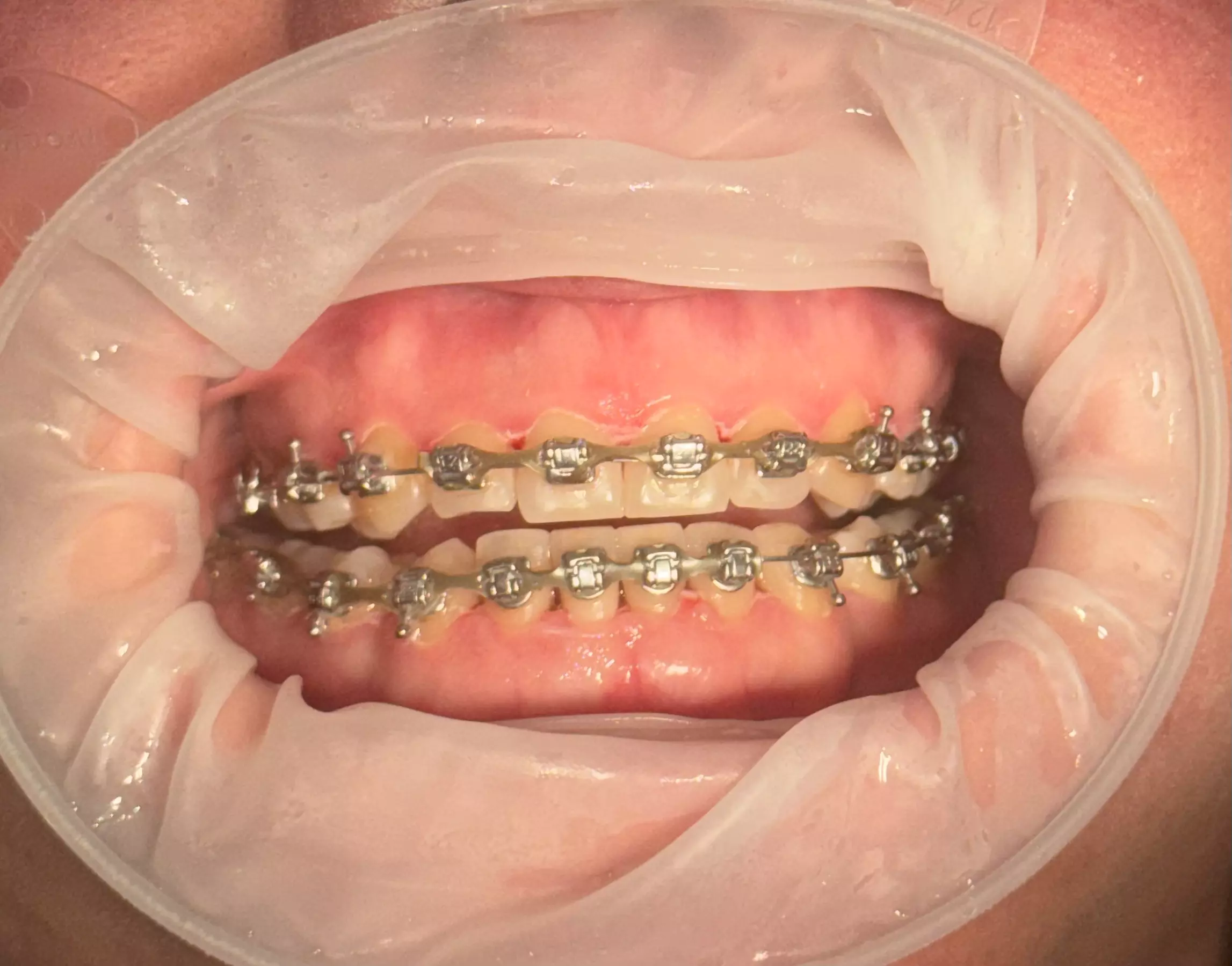 Zadbaj o uśmiech: skaling, piaskowanie i więcej – także dla osób z aparatem stałym w NZOZ Medicine (do -44%) - Image 3