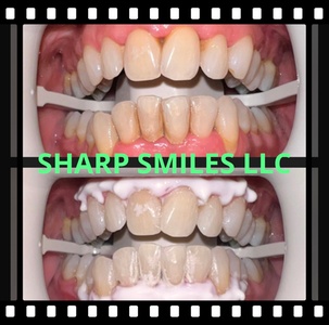 Gentle polish (remove Plaque and stains) - Sharp Smiles