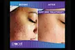 Rejuvenate with Procell Therapies: Face & Neck or Stretch Marks & More (Up to 37% Off) at Nouveau Toi Med Spa - Second Medium