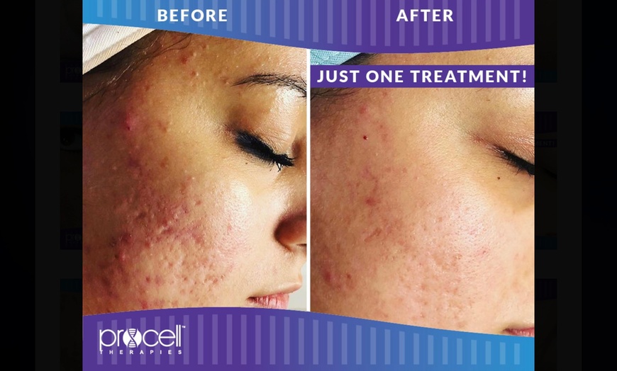 Image 4: Rejuvenate: Procell Therapies: Face & Neck or Stretch Marks & More