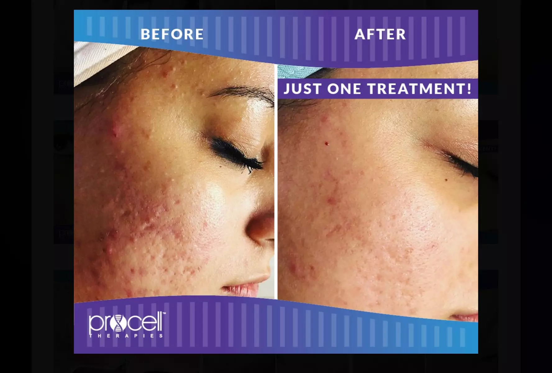 Rejuvenate: Procell Therapies: Face & Neck or Stretch Marks & More