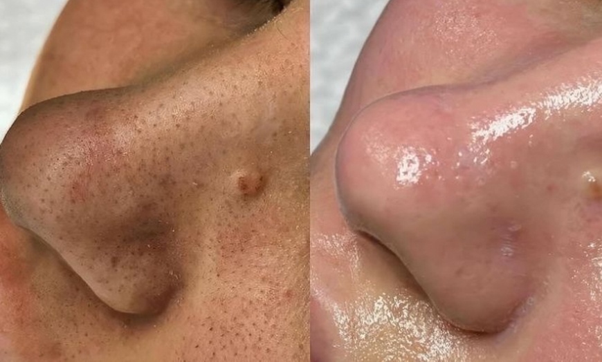 Image 3: Radiant Skin Awaits: Signature & Platinum Hydrafacial Packages