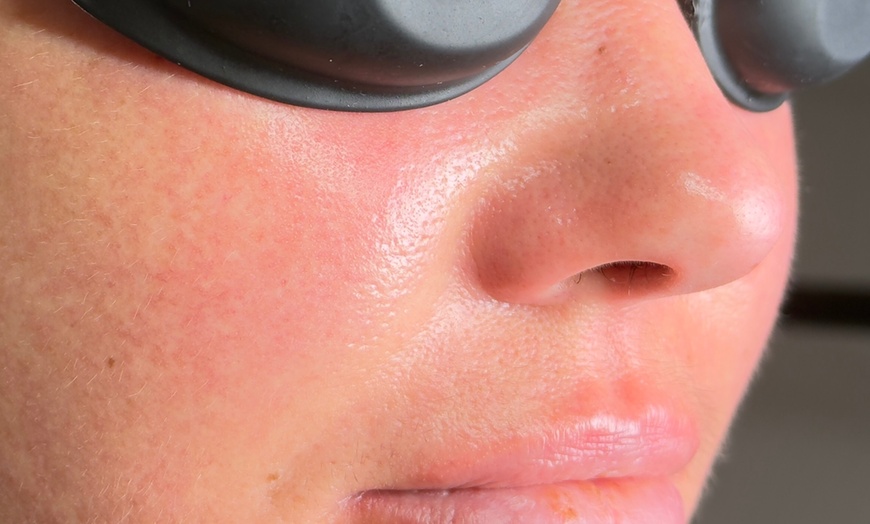 Image 5: Luxury Exosome Mesotherapy with PDRN for Skin Repair & Radiance