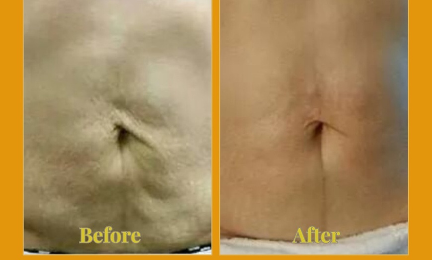 Image 8: Ultherapy Prime Treatment with for Face, Neck and Chest 