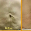 Image 8: Ultherapy Prime Treatment with for Face, Neck and Chest 