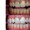 Image 1: Up to 30% Off on Teeth Whitening at Glow Beaute