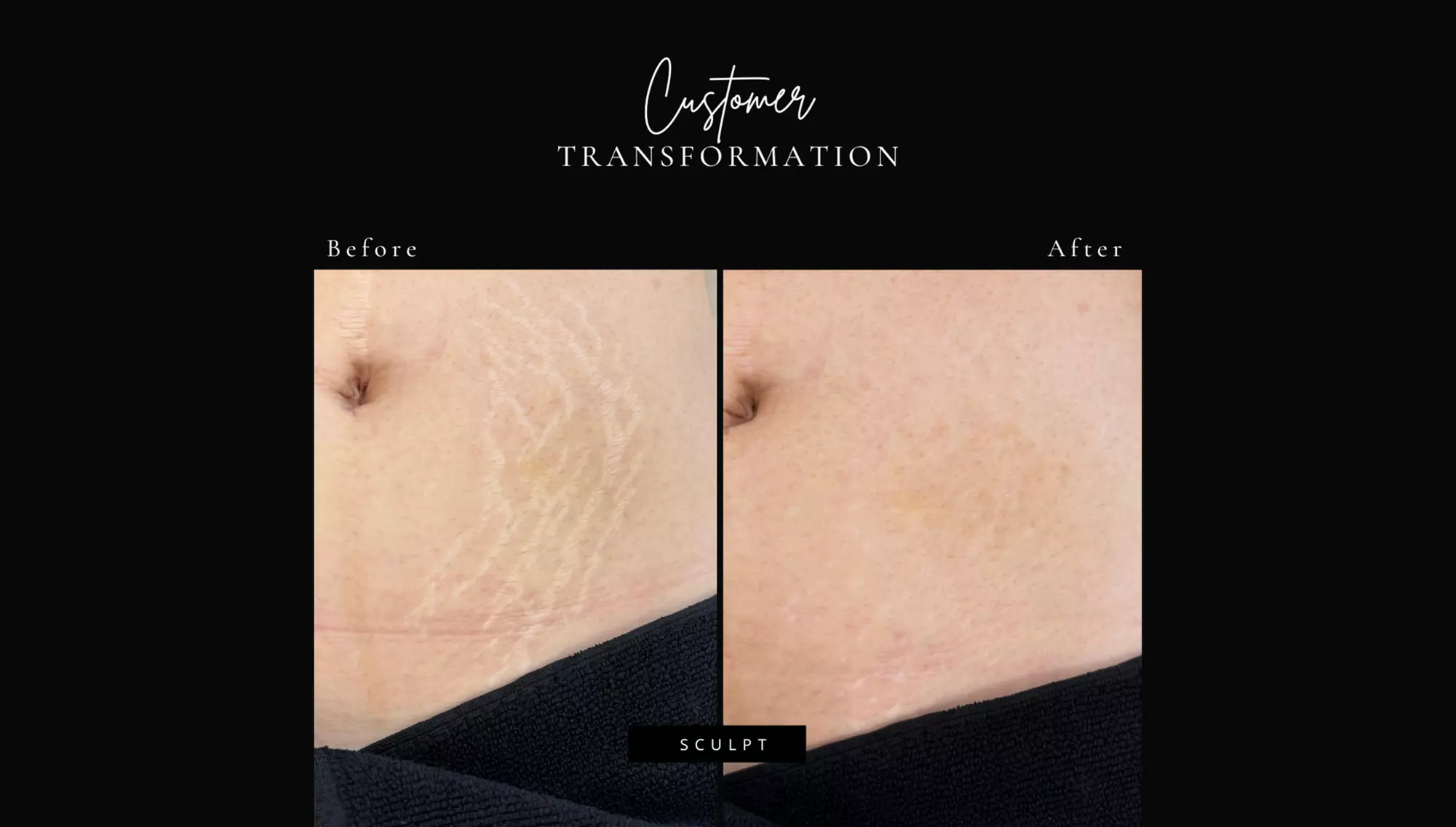 Up to 50% Off on Spa / Stretch Mark Revision Inkless Paramedical or camouflage on Small, Medium or Large Area