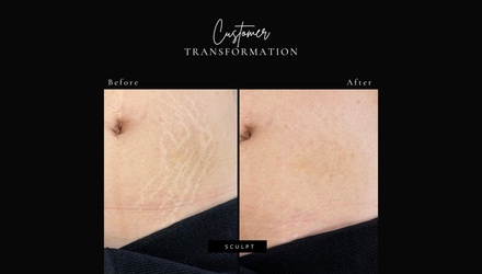 Stretch Mark Revision Inkless Paramedical or camouflage ( small Area ) - Sculpt Body Contouring & More
