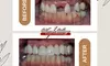 Warner Village Cosmetic & Family Dentistry Offers Exam, Cleaning, X-ray and Veneer Options (Up to 73% Off)