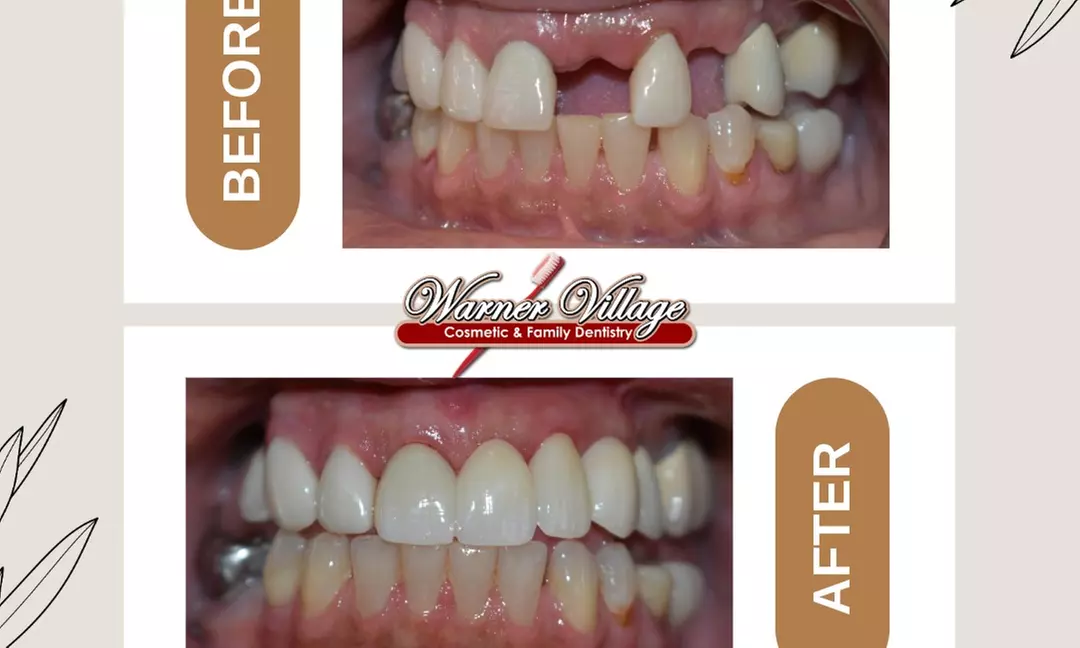 Transform Your Smile with Exam, Cleaning and Veneer Options