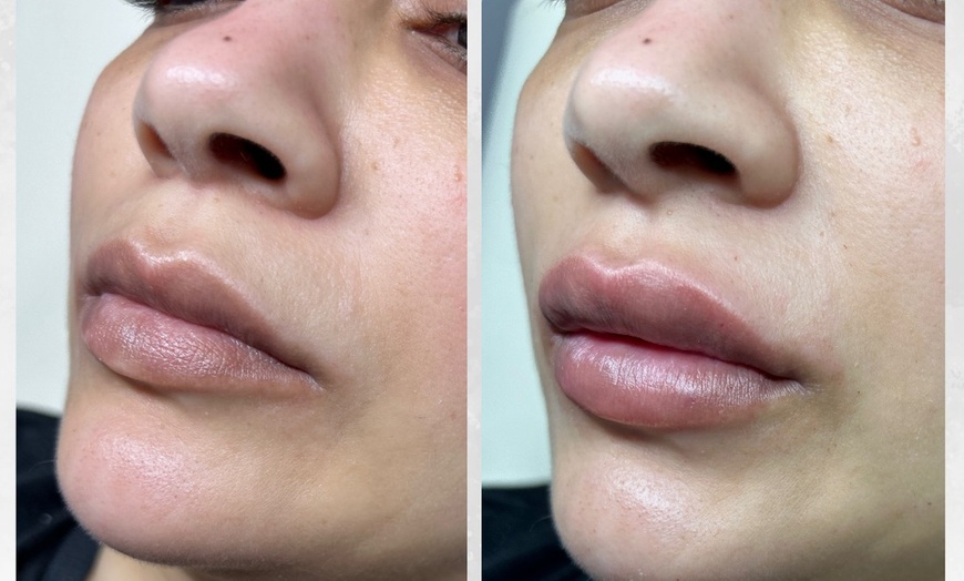 Image 7: Up to 25% Off on Facial - Anti-Ageing at Tranquil Aesthetics