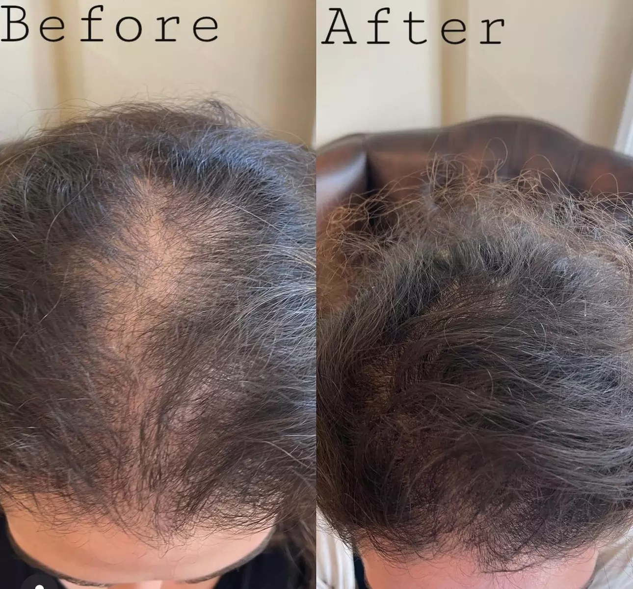 PRP / Platelet Rich Plasma / Vampire at Dr S Aesthetics