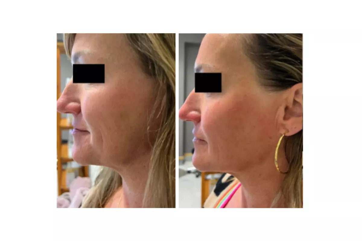 Glow + Sculpt: The Ultimate Hydraglow Microdermabrasion