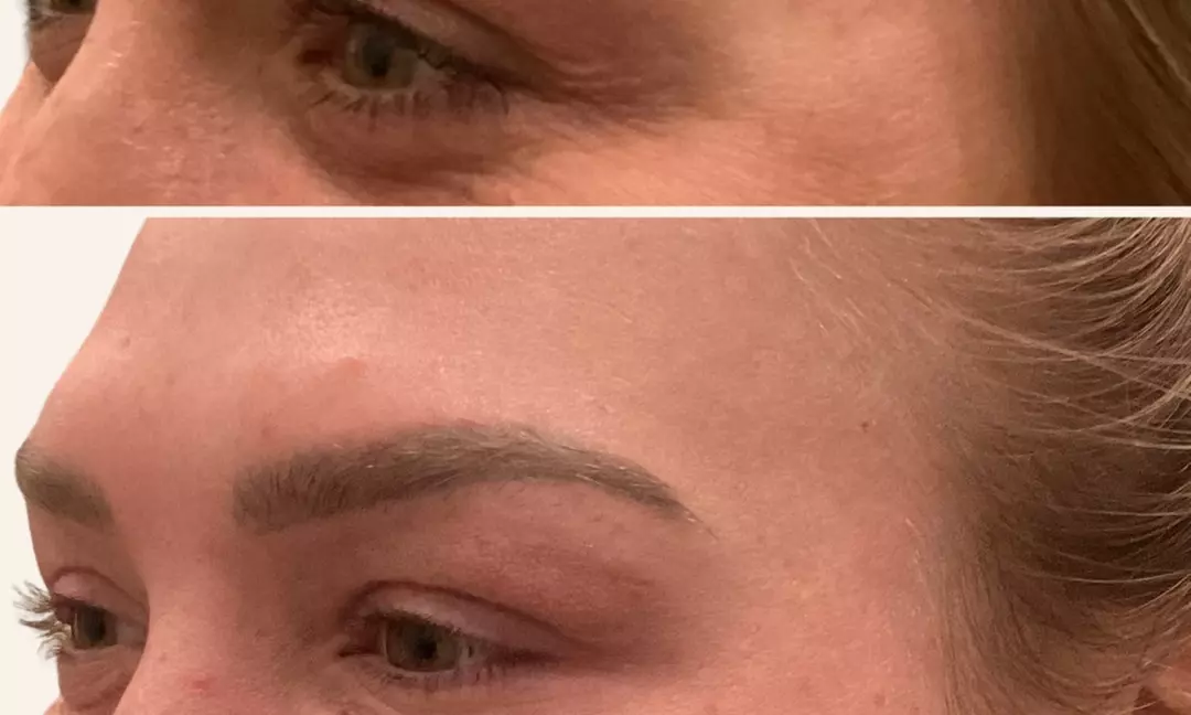 Smooth Your Skin with 20, 40 or 60 Units of Xeomin Injections